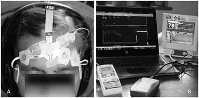 Hypnosis measured with monitors of anesthetic depth – EEG changes during the test for Harvard Group Scale of Hypnotic Susceptibility
